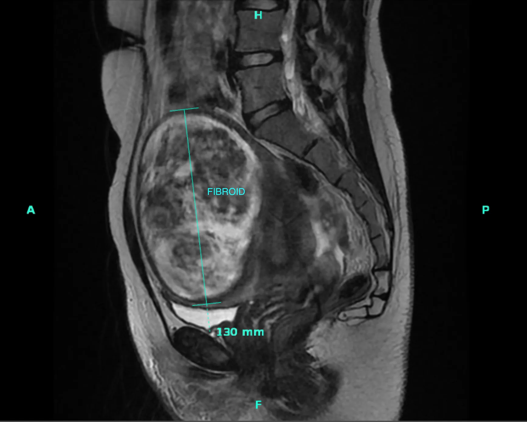 How Large Fibroids Are Safely Removed with Minimally Invasive Surgery