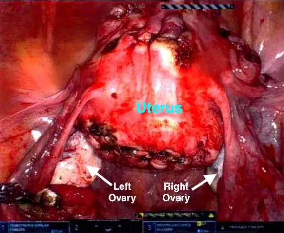 Fully repaired uterus after removal of all fibroids, with ovaries, tubes, bladder, and rectum clearly visible