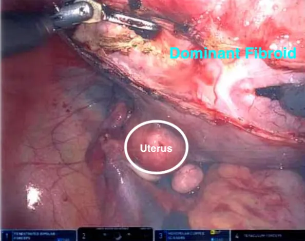 Laparoscopic view of the uterus compressed beneath the weight of the dominant fibroid